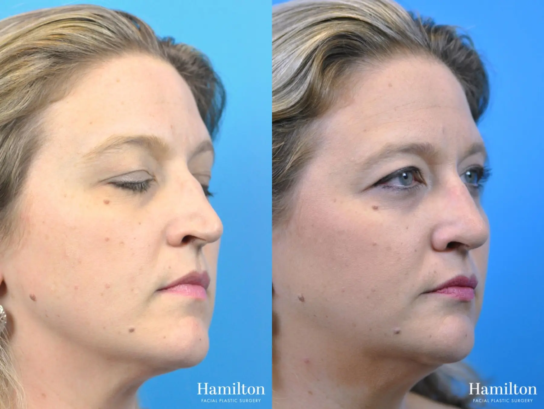 Rhinoplasty: Patient 39 - Before and After 3