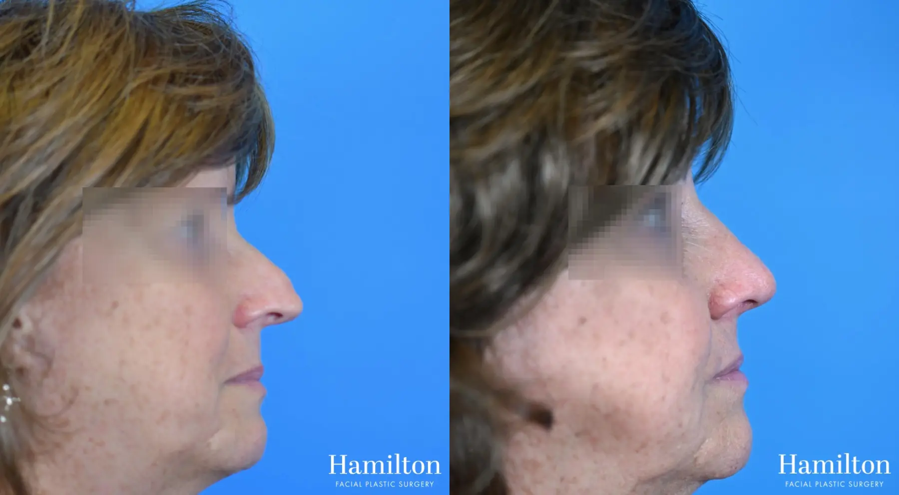 Rhinoplasty: Patient 21 - Before and After 2