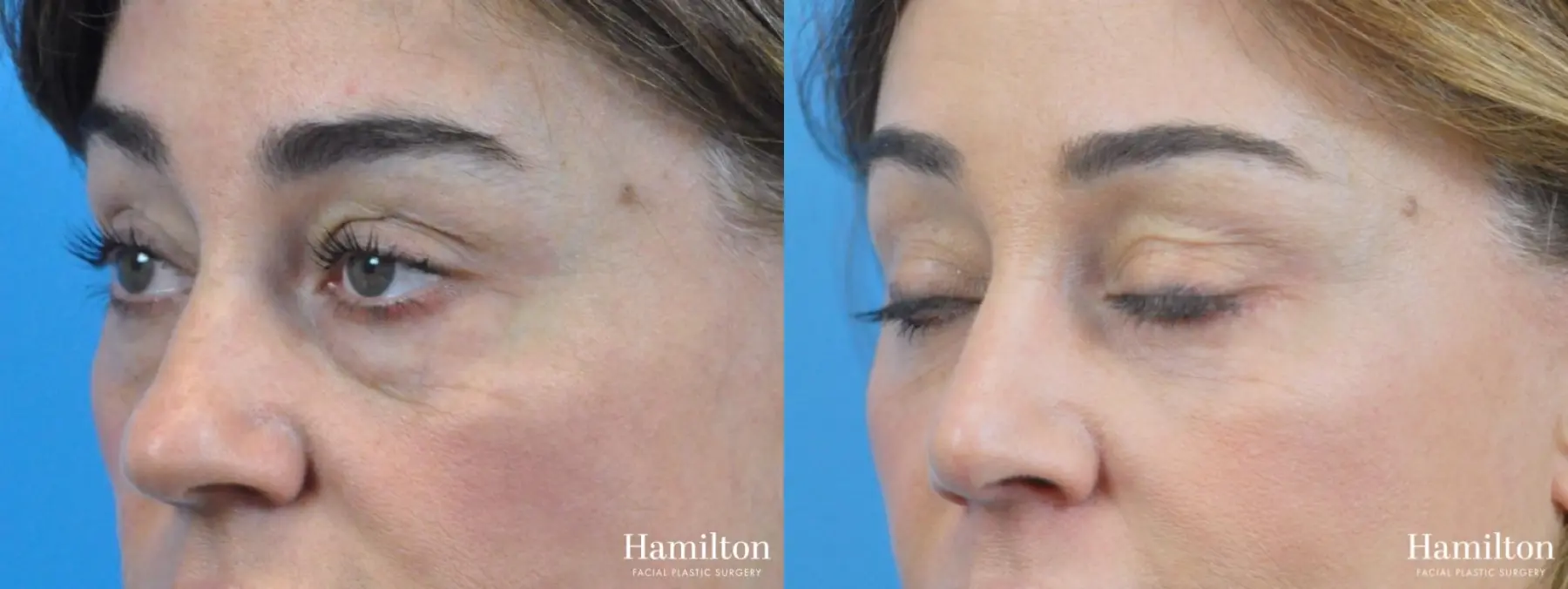 Rhinoplasty: Patient 38 - Before and After 3