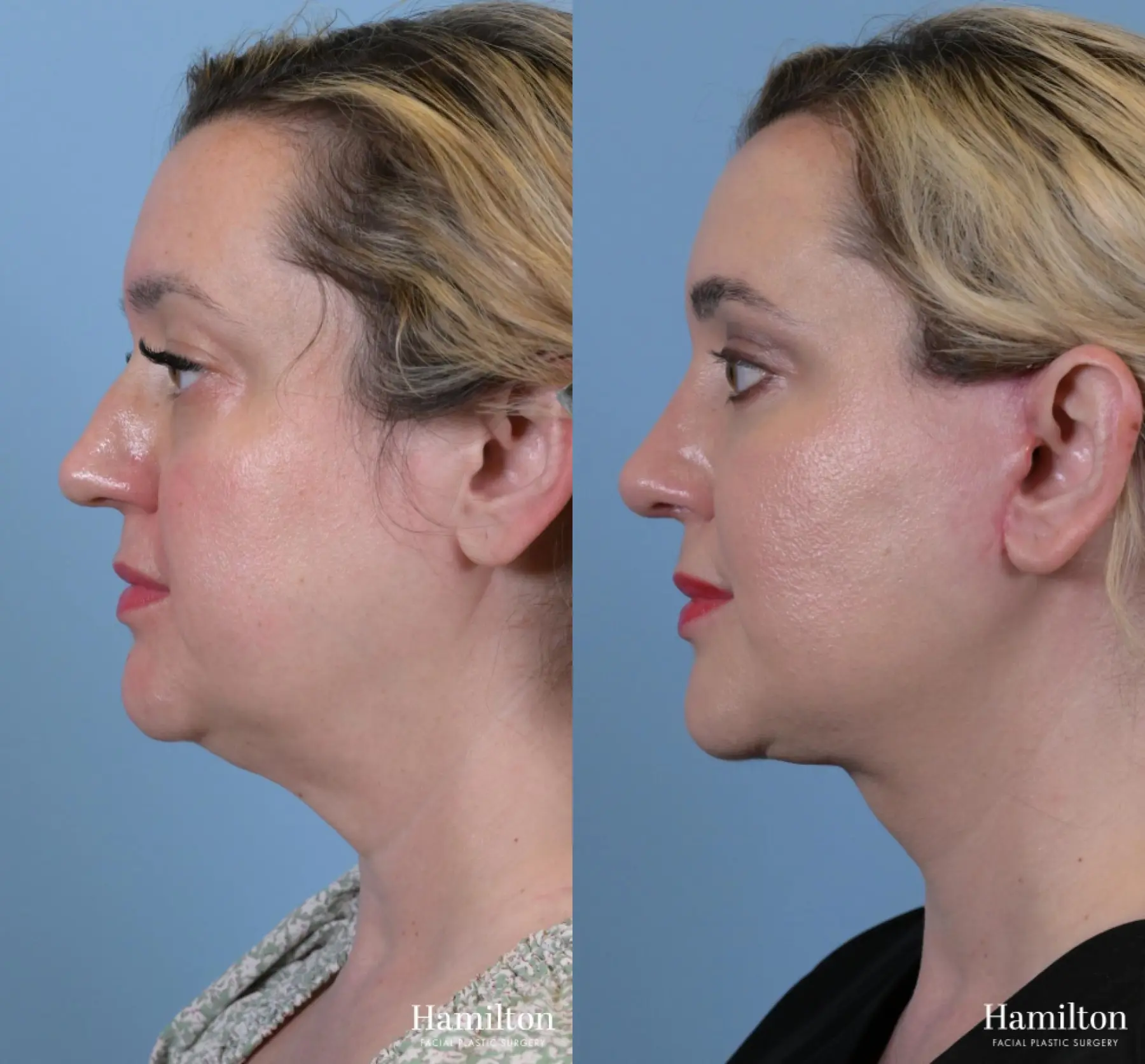 Rhinoplasty: Patient 17 - Before and After 4