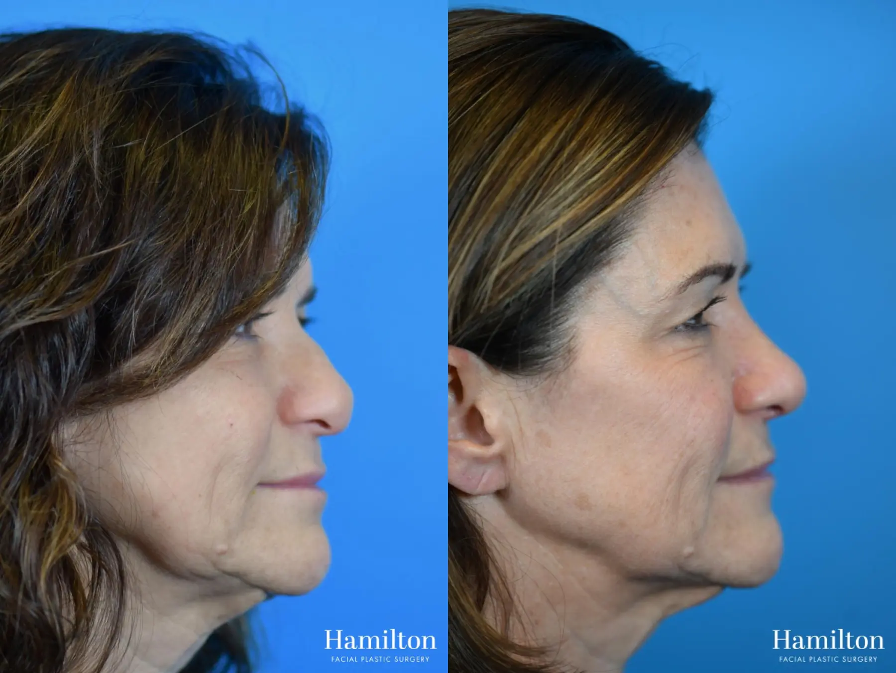 Rhinoplasty: Patient 10 - Before and After 5