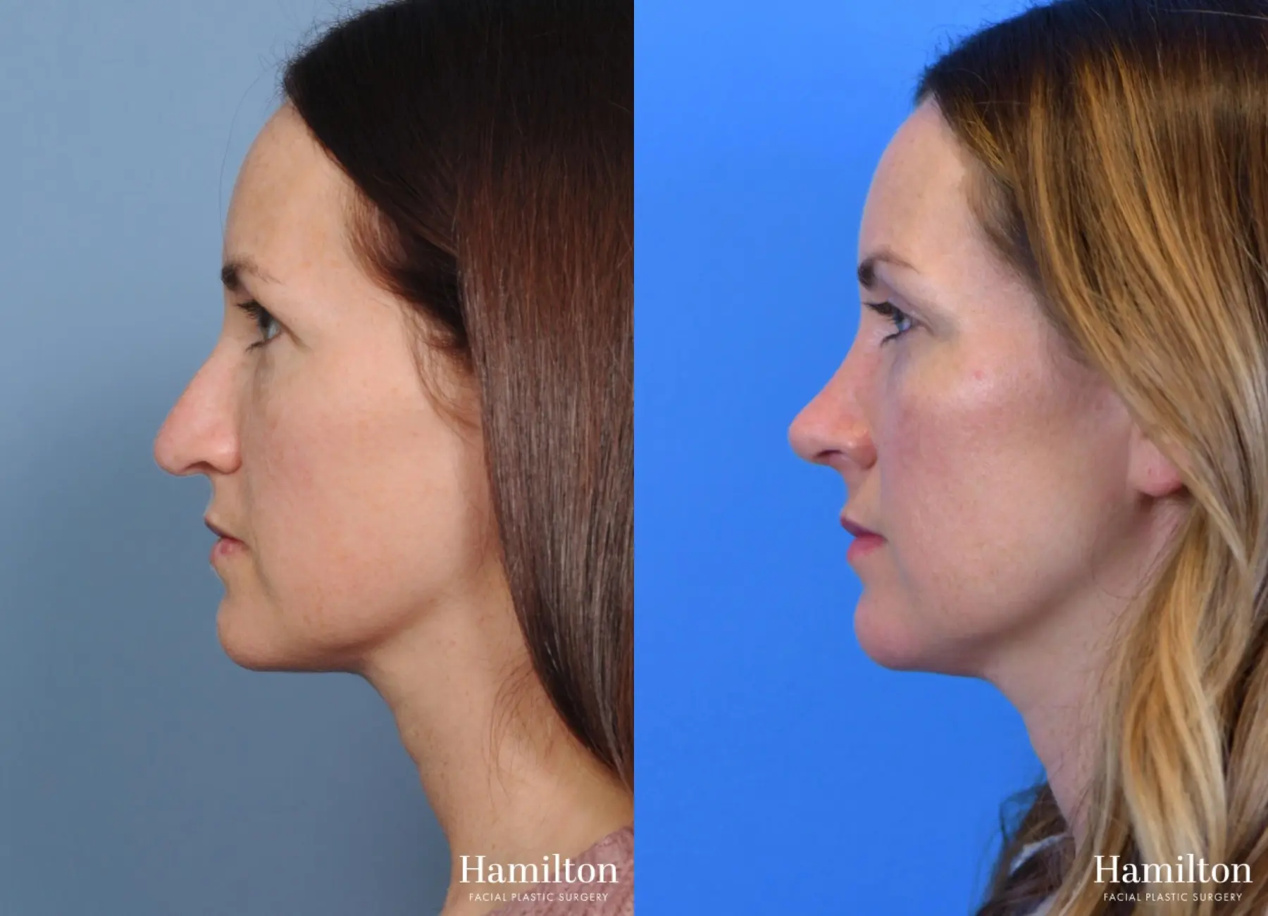 Rhinoplasty: Patient 8 - Before and After  