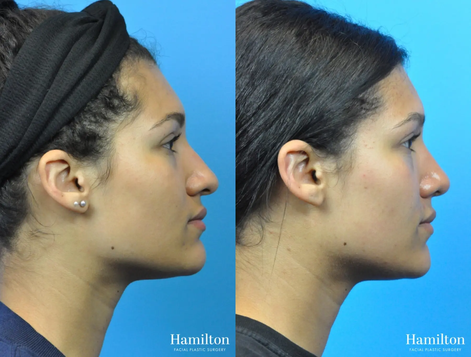 Rhinoplasty: Patient 45 - Before and After 3