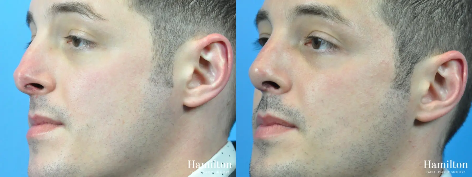 Rhinoplasty: Patient 40 - Before and After 3
