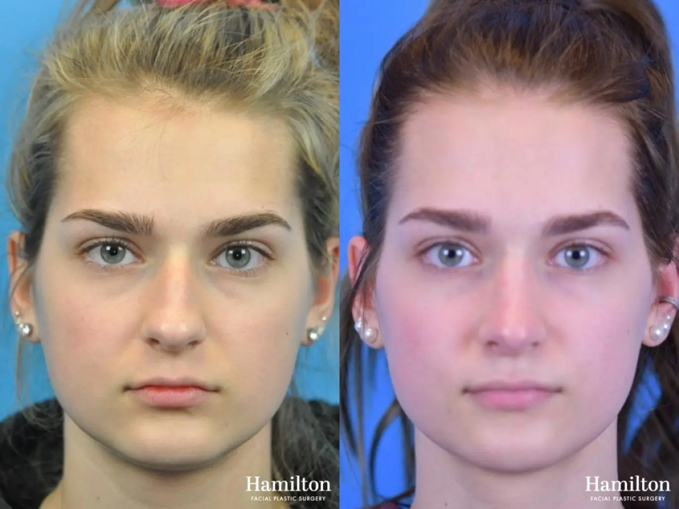 Rhinoplasty: Patient 25 - Before and After 3