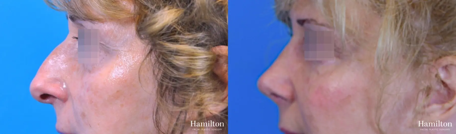 Rhinoplasty: Patient 47 - Before and After 3