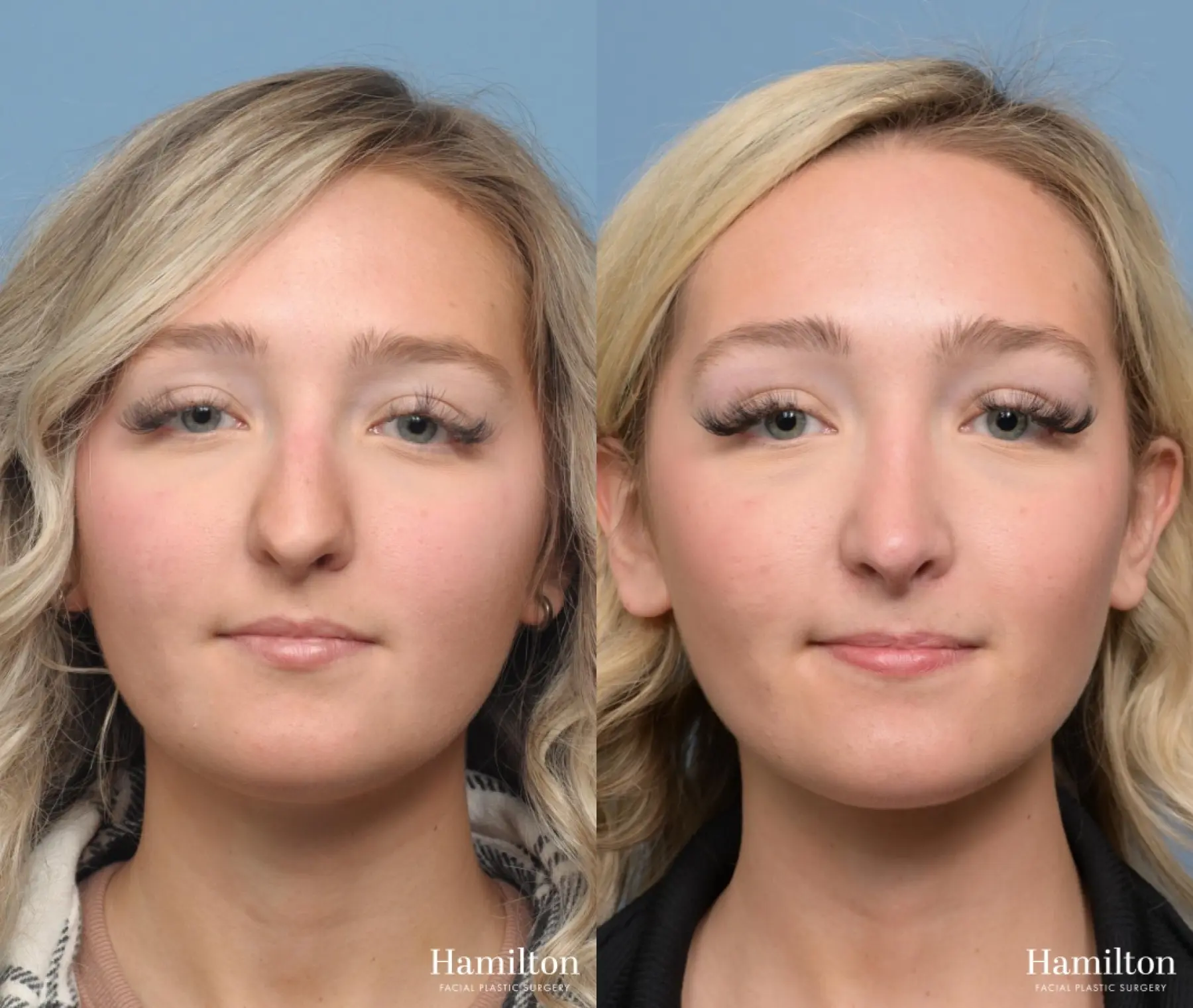 Rhinoplasty: Patient 7 - Before and After  