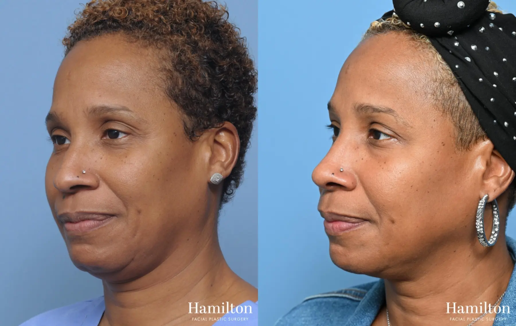 Rhinoplasty: Patient 15 - Before and After 4