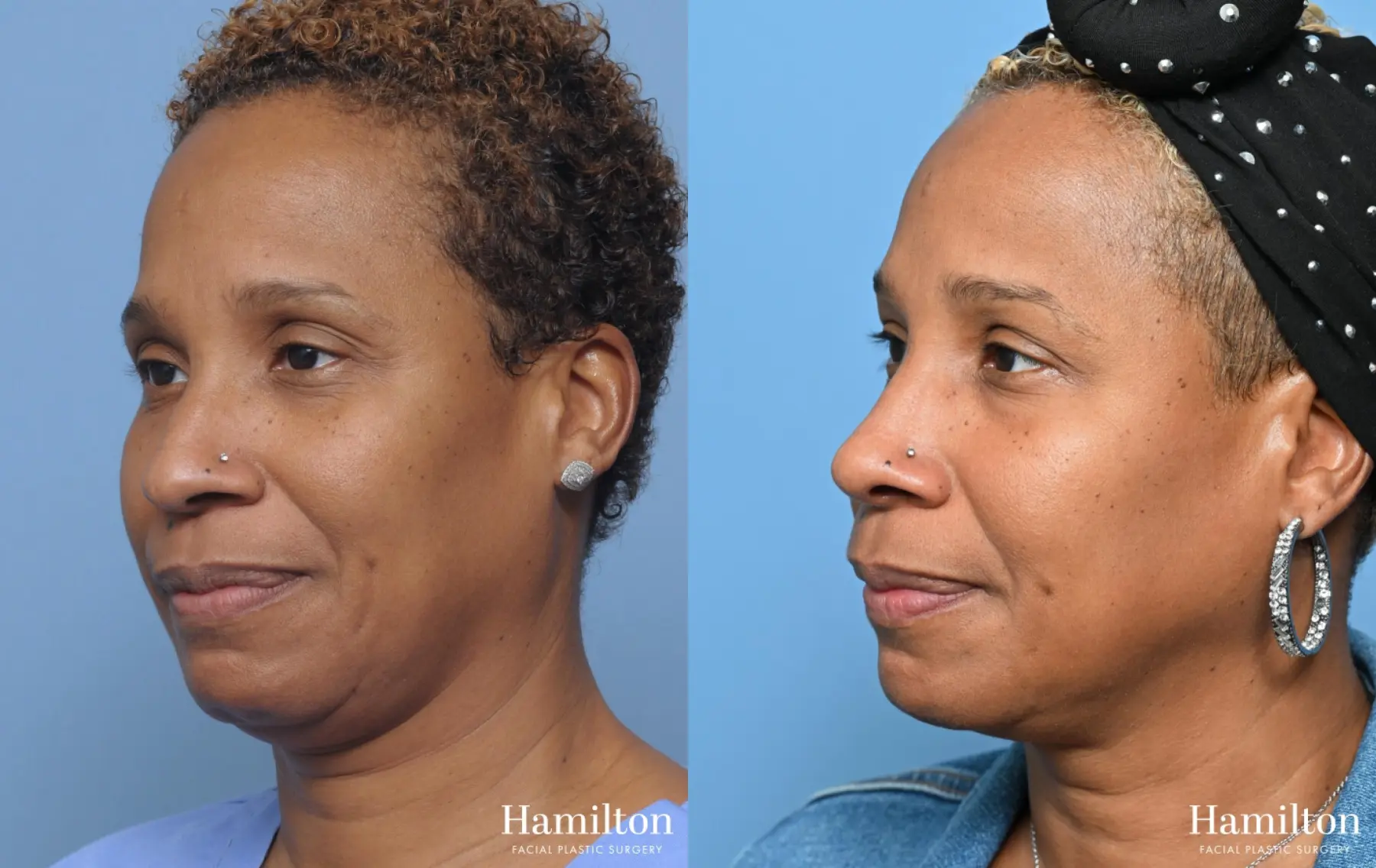 Rhinoplasty: Patient 11 - Before and After 4