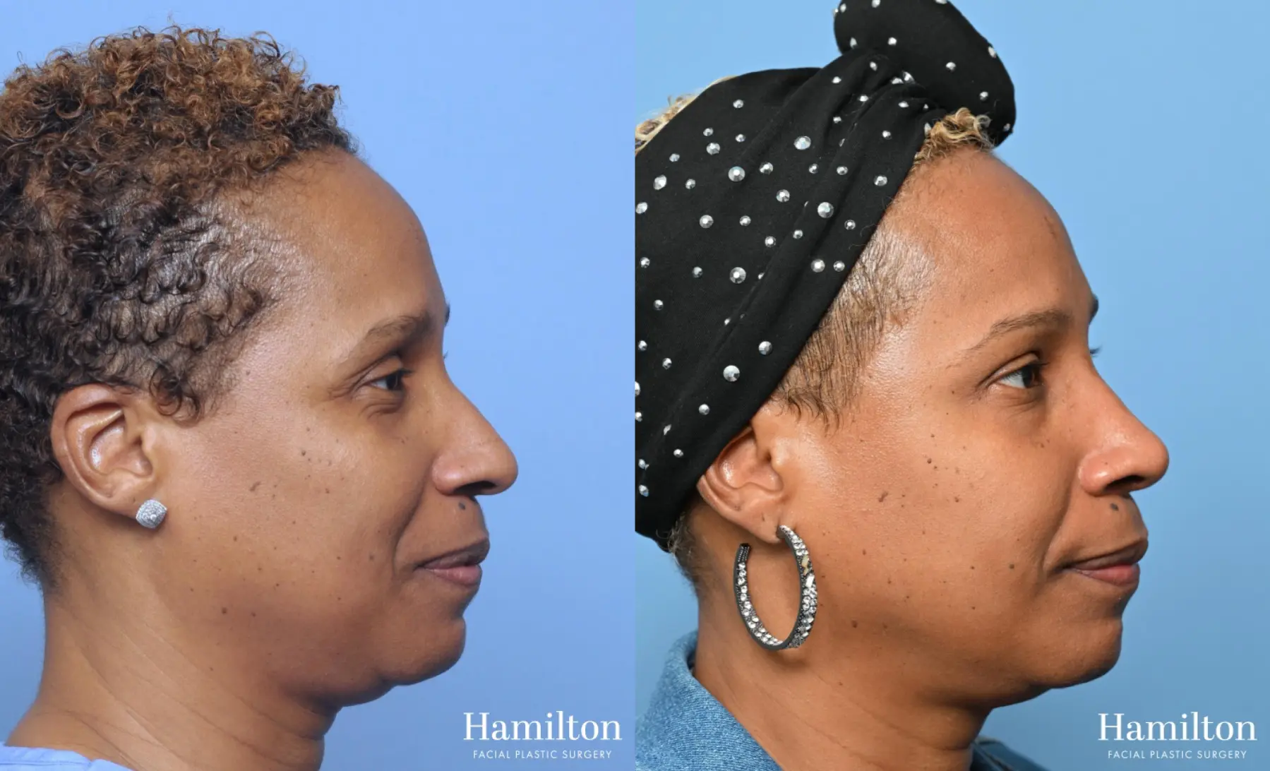 Rhinoplasty: Patient 10 - Before and After  