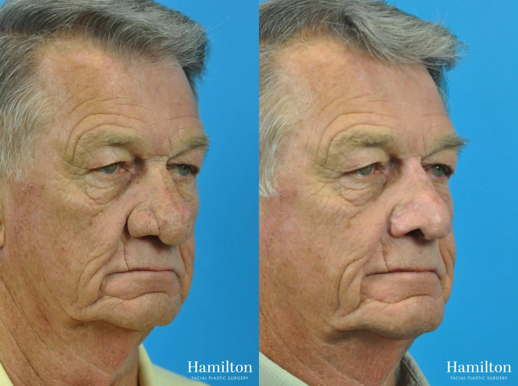 Rhinoplasty: Patient 31 - Before and After 1