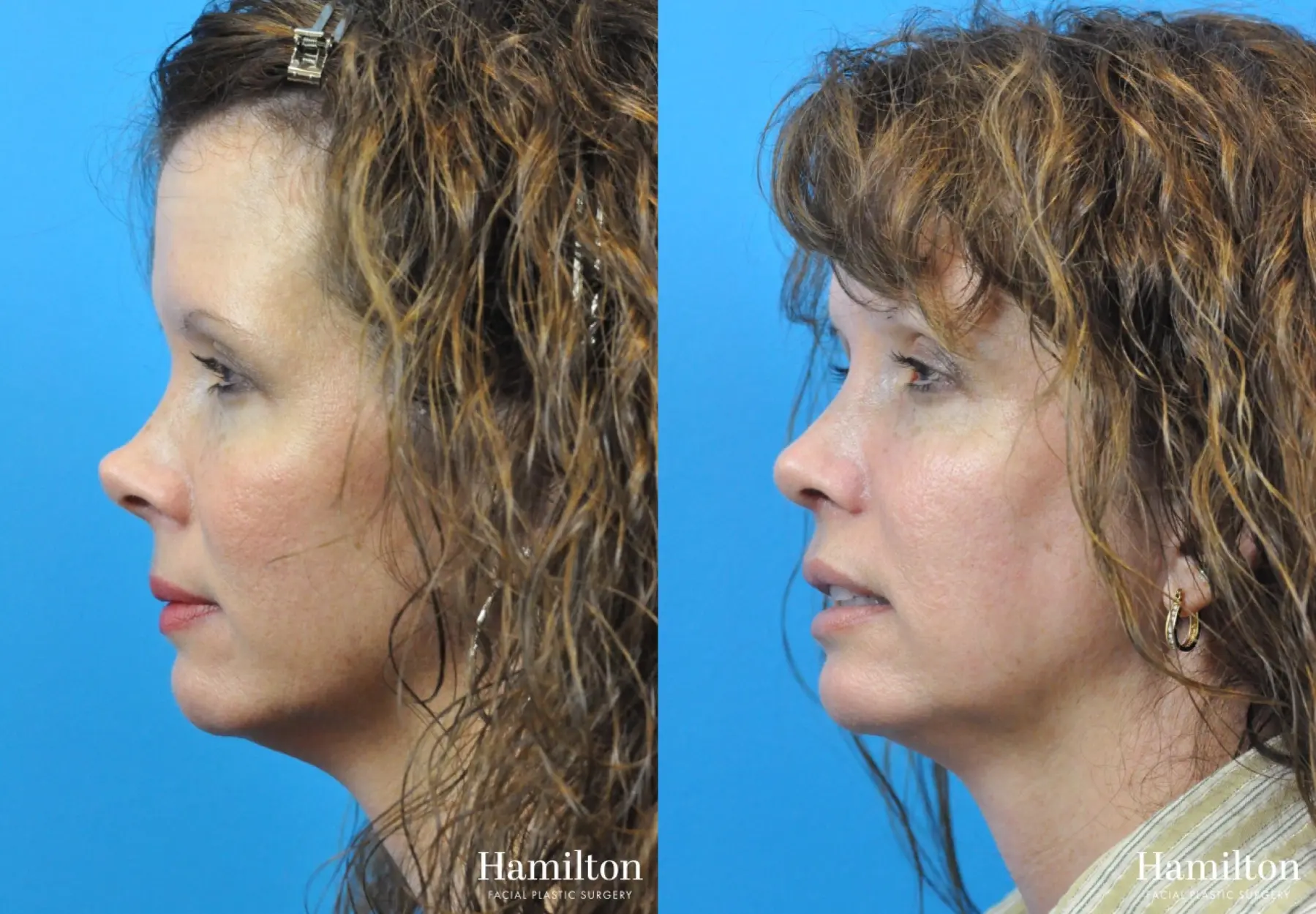 Rhinoplasty: Patient 26 - Before and After 1