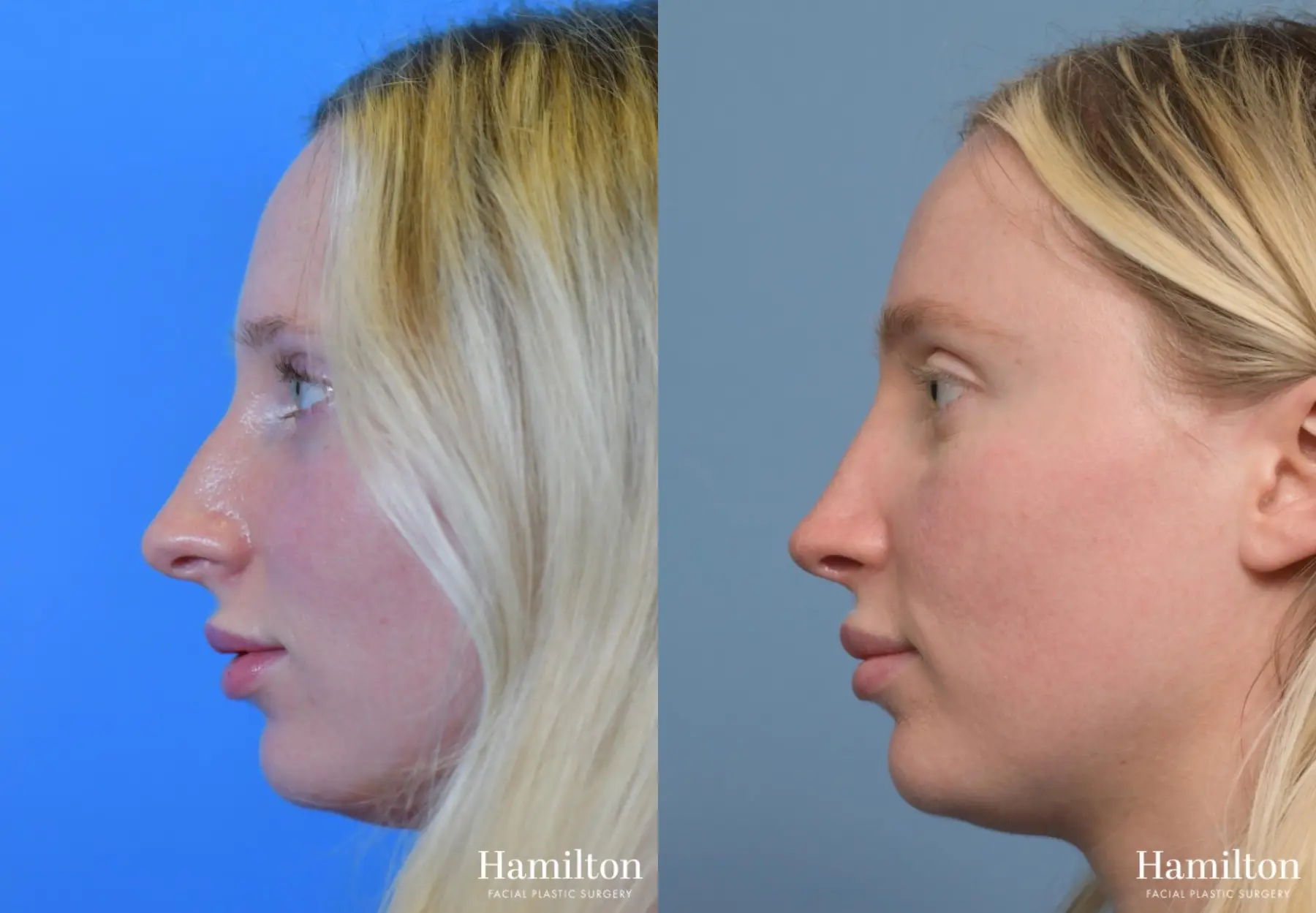 Rhinoplasty: Patient 4 - Before and After 3