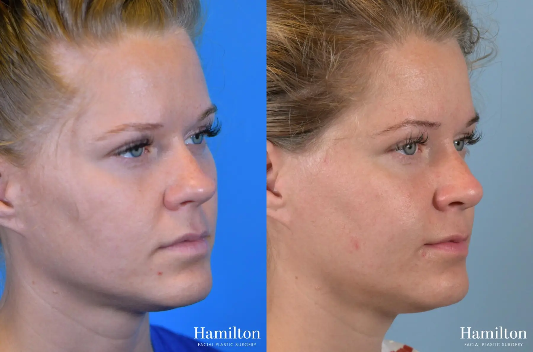 Rhinoplasty: Patient 52 - Before and After 1
