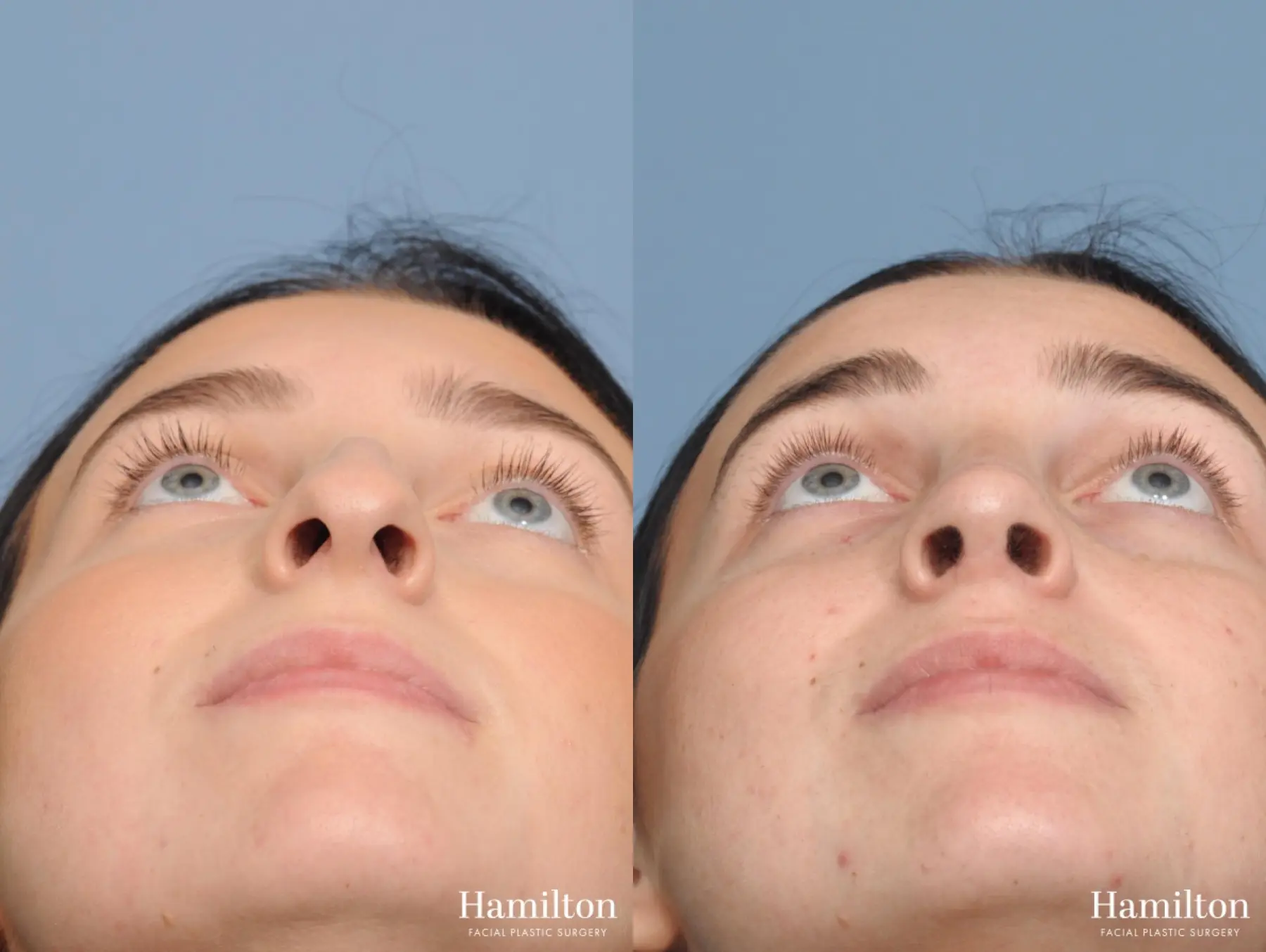 Rhinoplasty: Patient 2 - Before and After 5