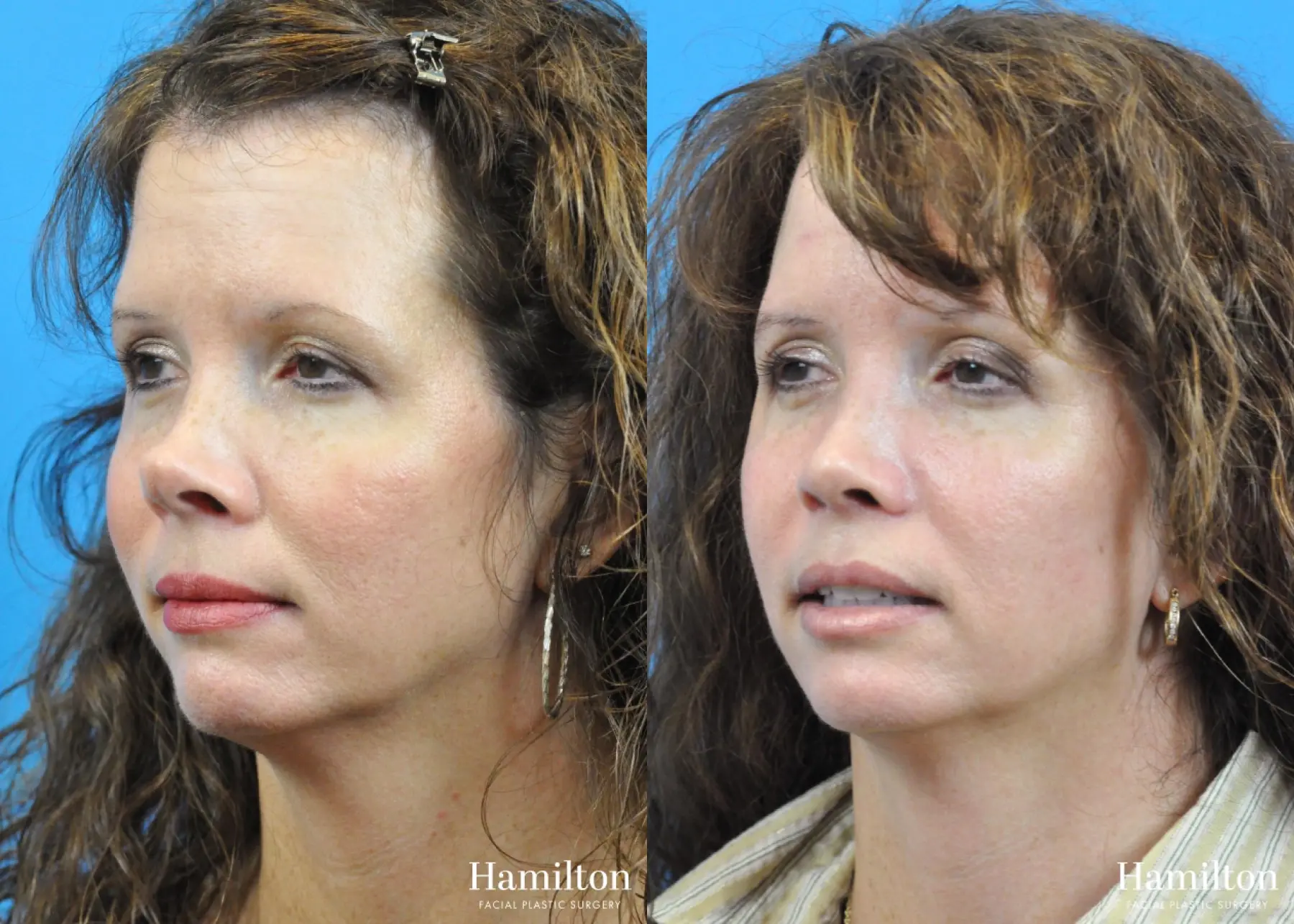 Rhinoplasty: Patient 26 - Before and After 3