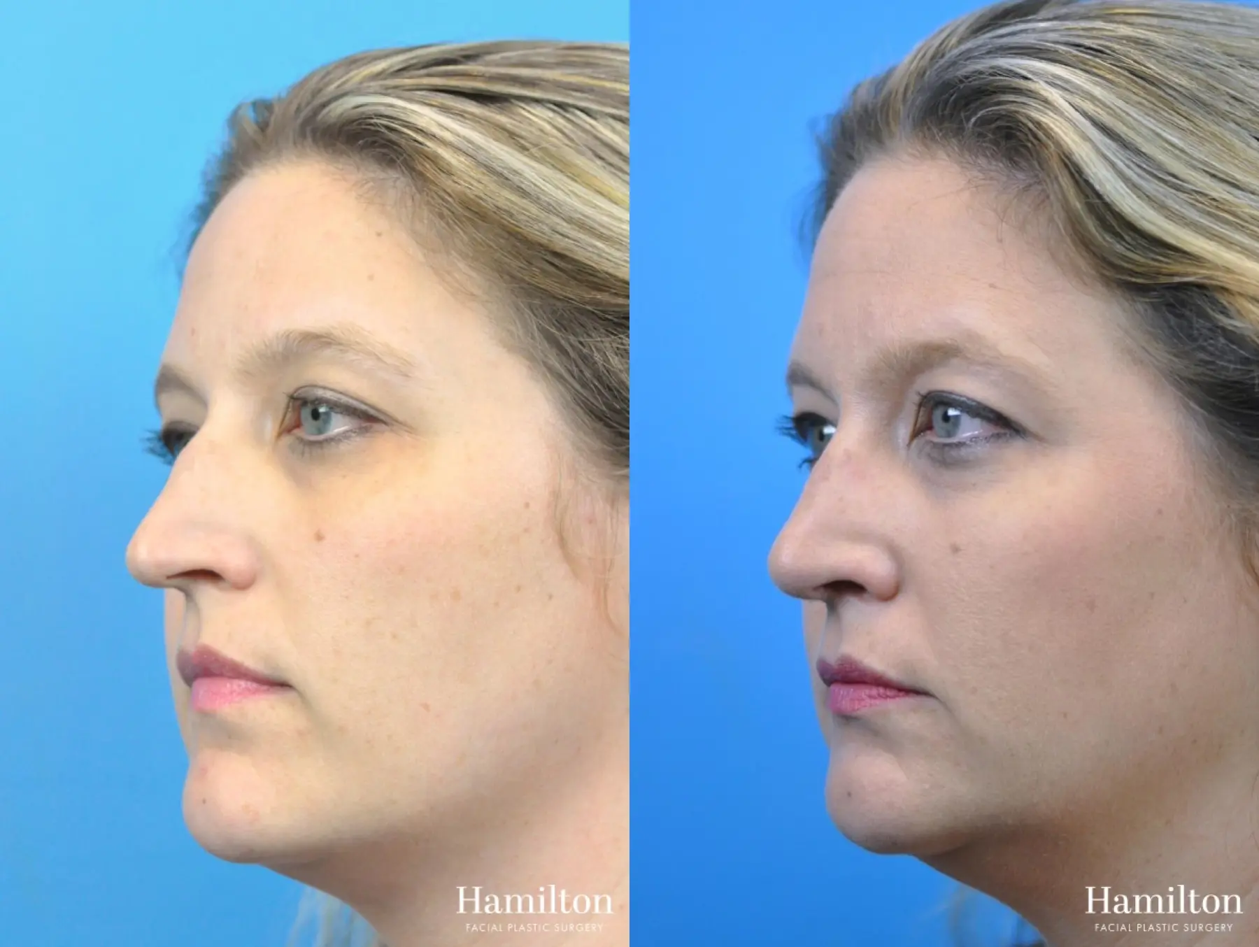 Rhinoplasty: Patient 39 - Before and After 4