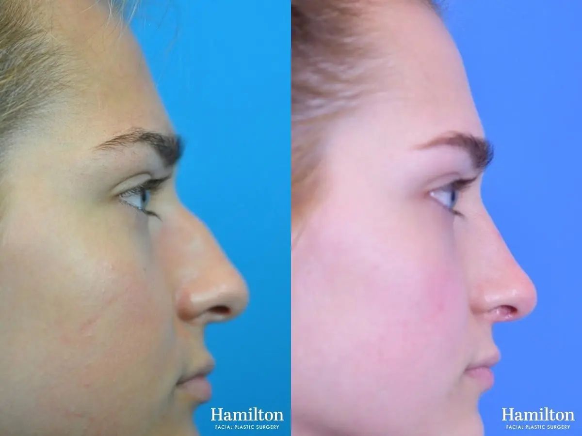 Rhinoplasty: Patient 25 - Before and After 1