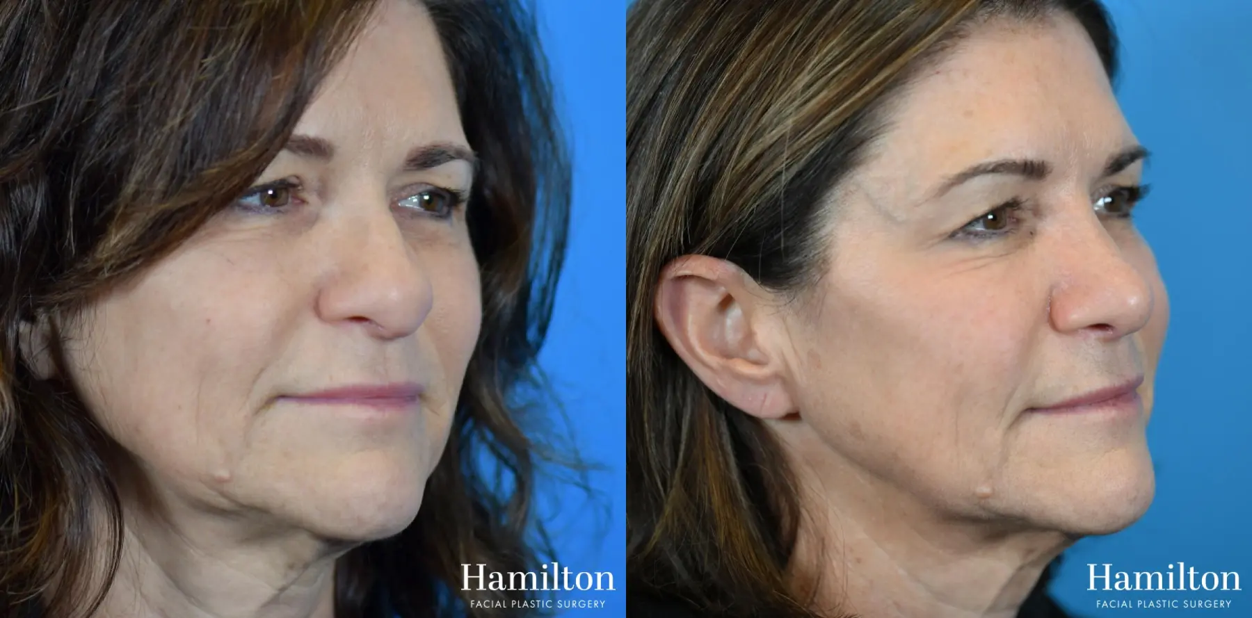 Rhinoplasty: Patient 14 - Before and After 4