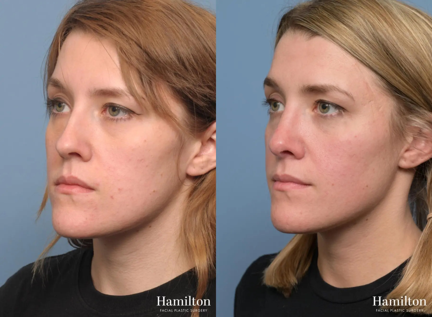Rhinoplasty: Patient 3 - Before and After 5
