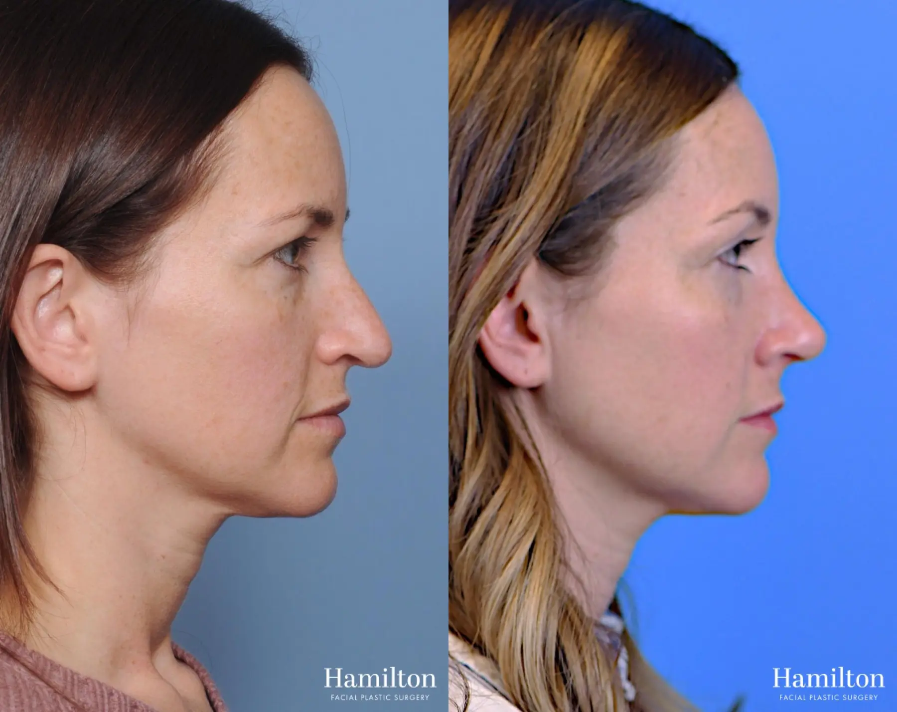 Rhinoplasty: Patient 8 - Before and After 4