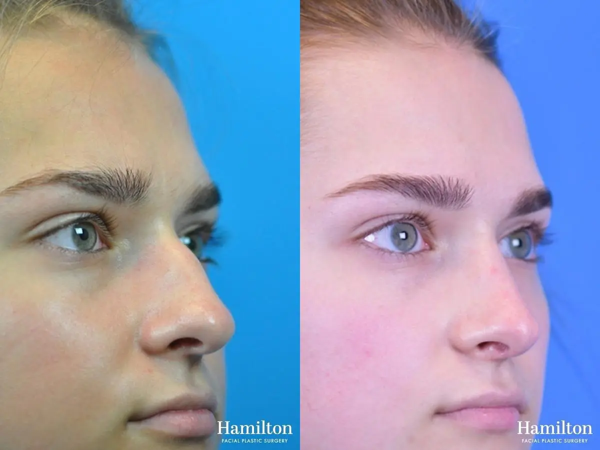Rhinoplasty: Patient 17 - Before and After 2