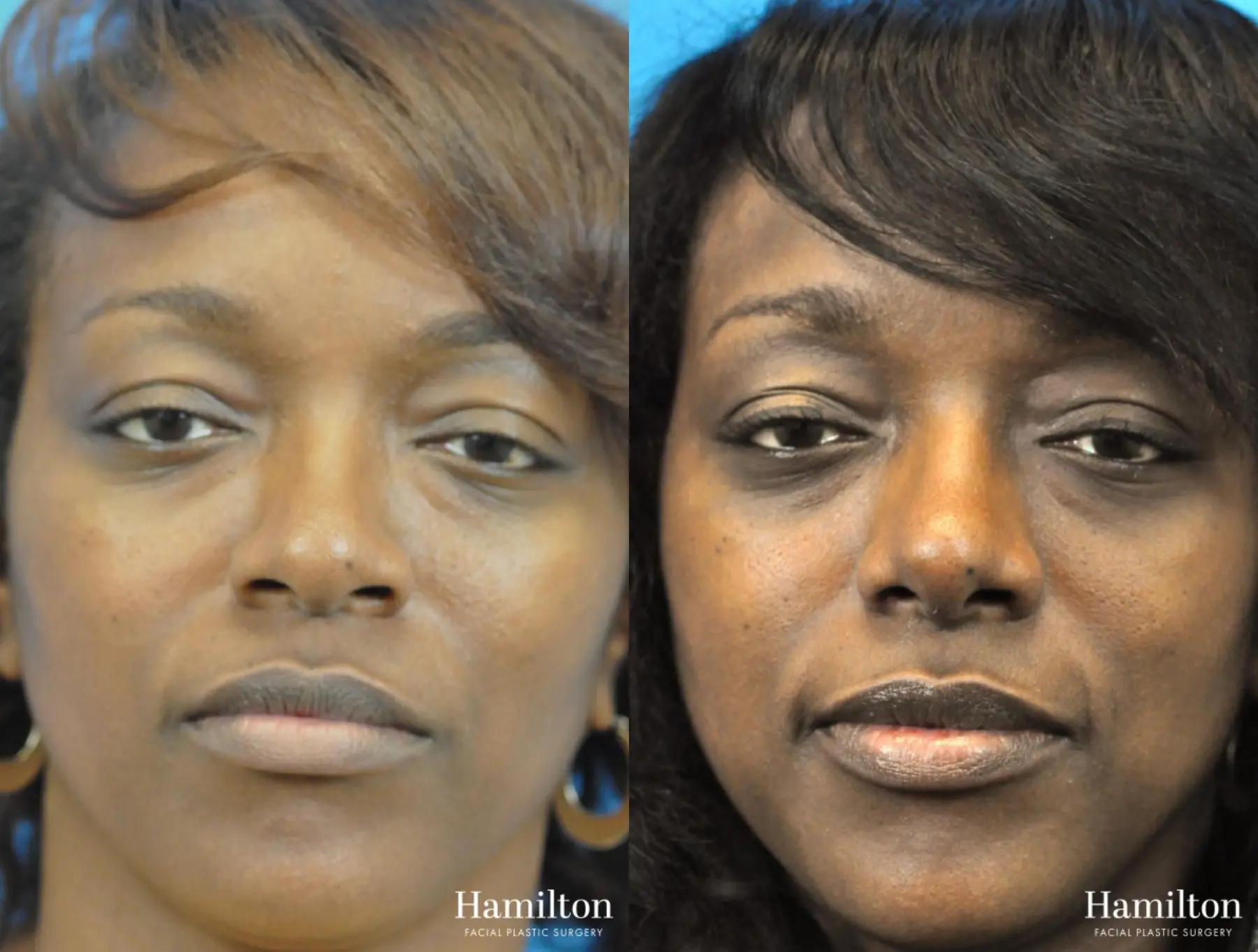 Rhinoplasty: Patient 28 - Before and After 3