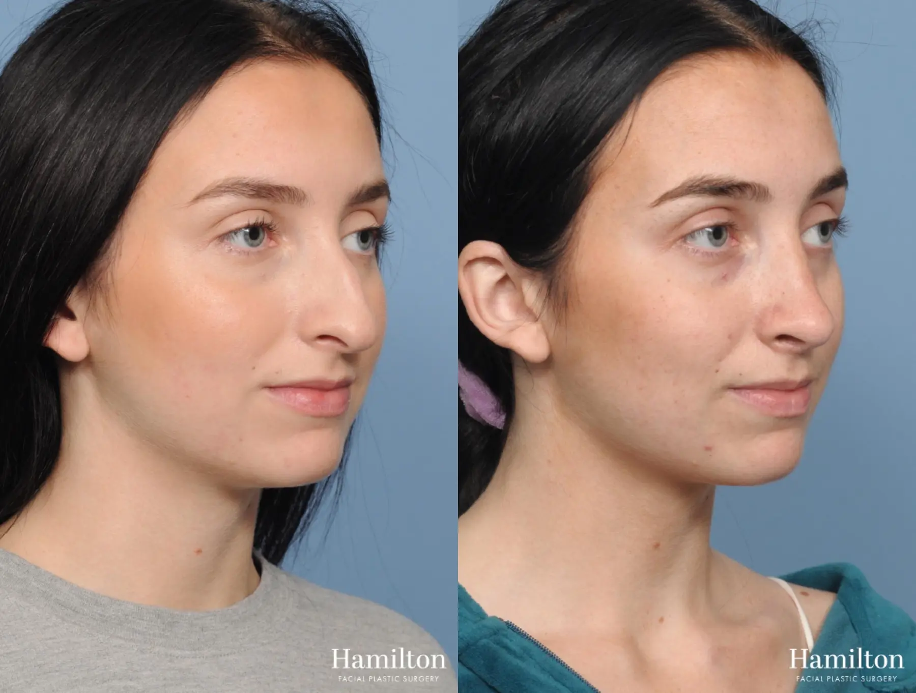 Rhinoplasty: Patient 2 - Before and After 3