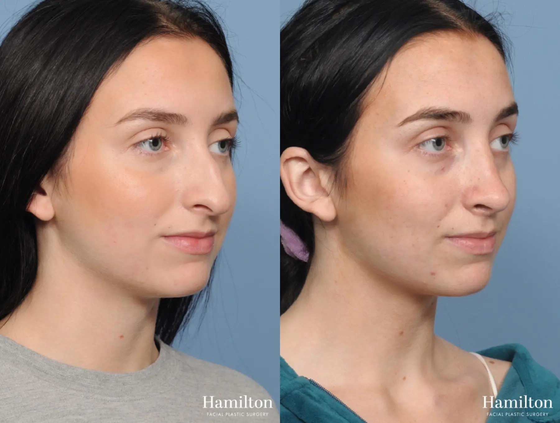 Rhinoplasty: Patient 4 - Before and After 3