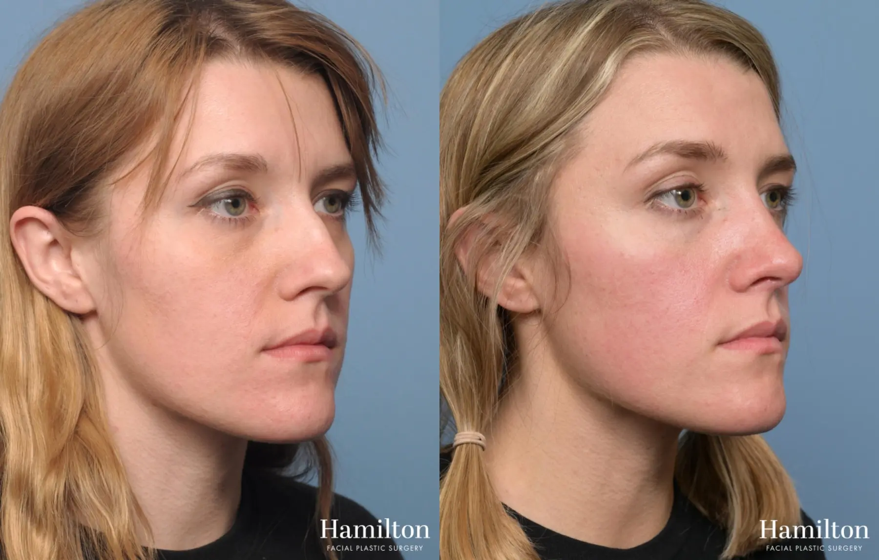 Rhinoplasty: Patient 3 - Before and After 3