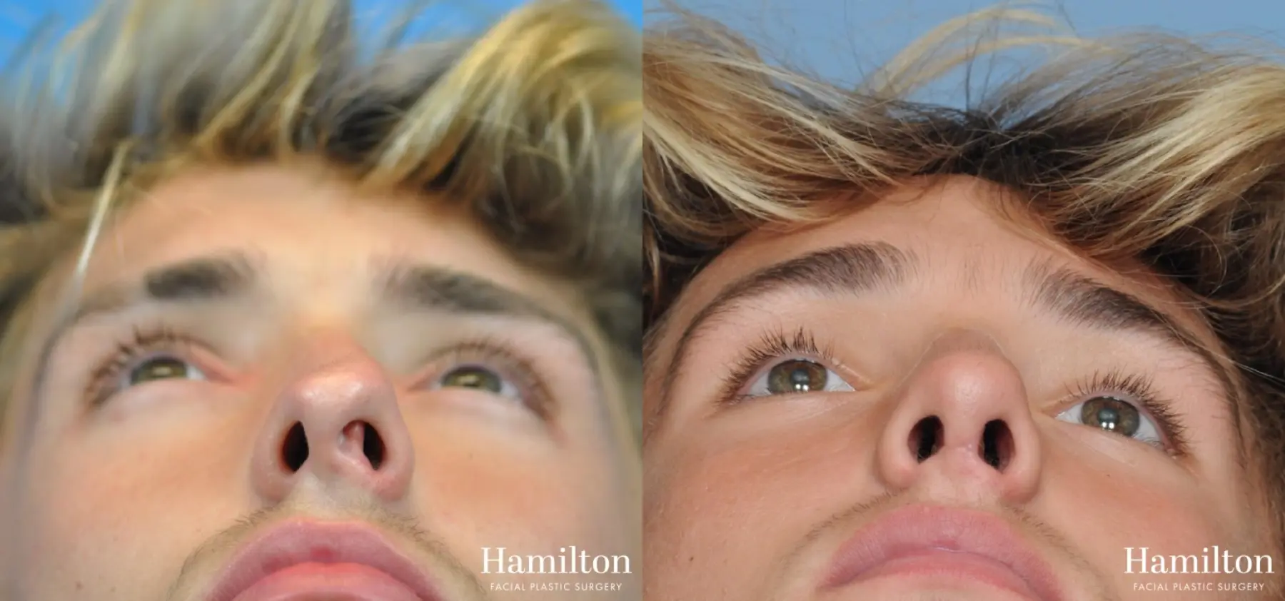 Rhinoplasty: Patient 14 - Before and After 2