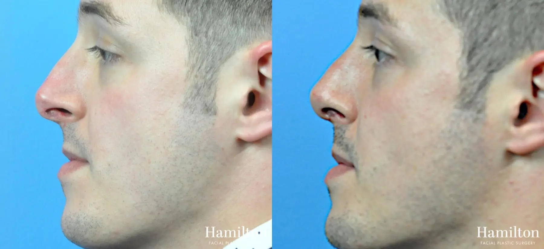Rhinoplasty: Patient 40 - Before and After 6