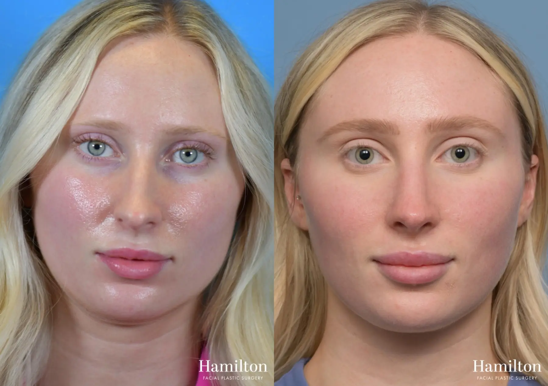 Rhinoplasty: Patient 4 - Before and After 5