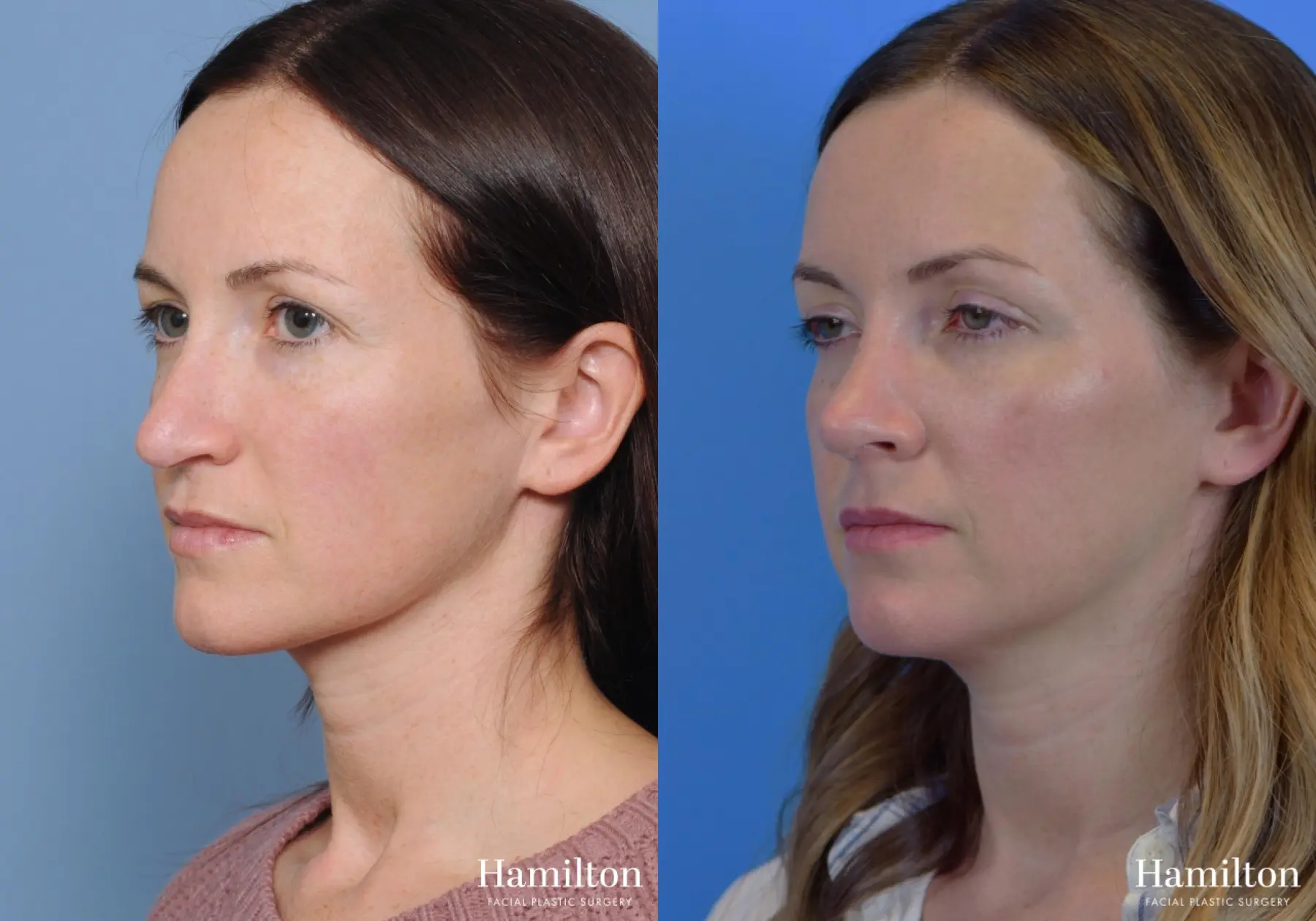 Rhinoplasty: Patient 8 - Before and After 6