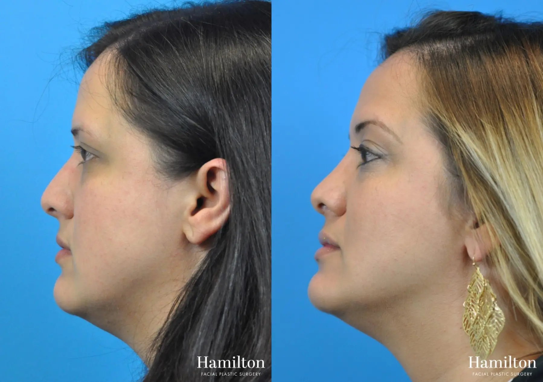 Rhinoplasty: Patient 41 - Before and After 3