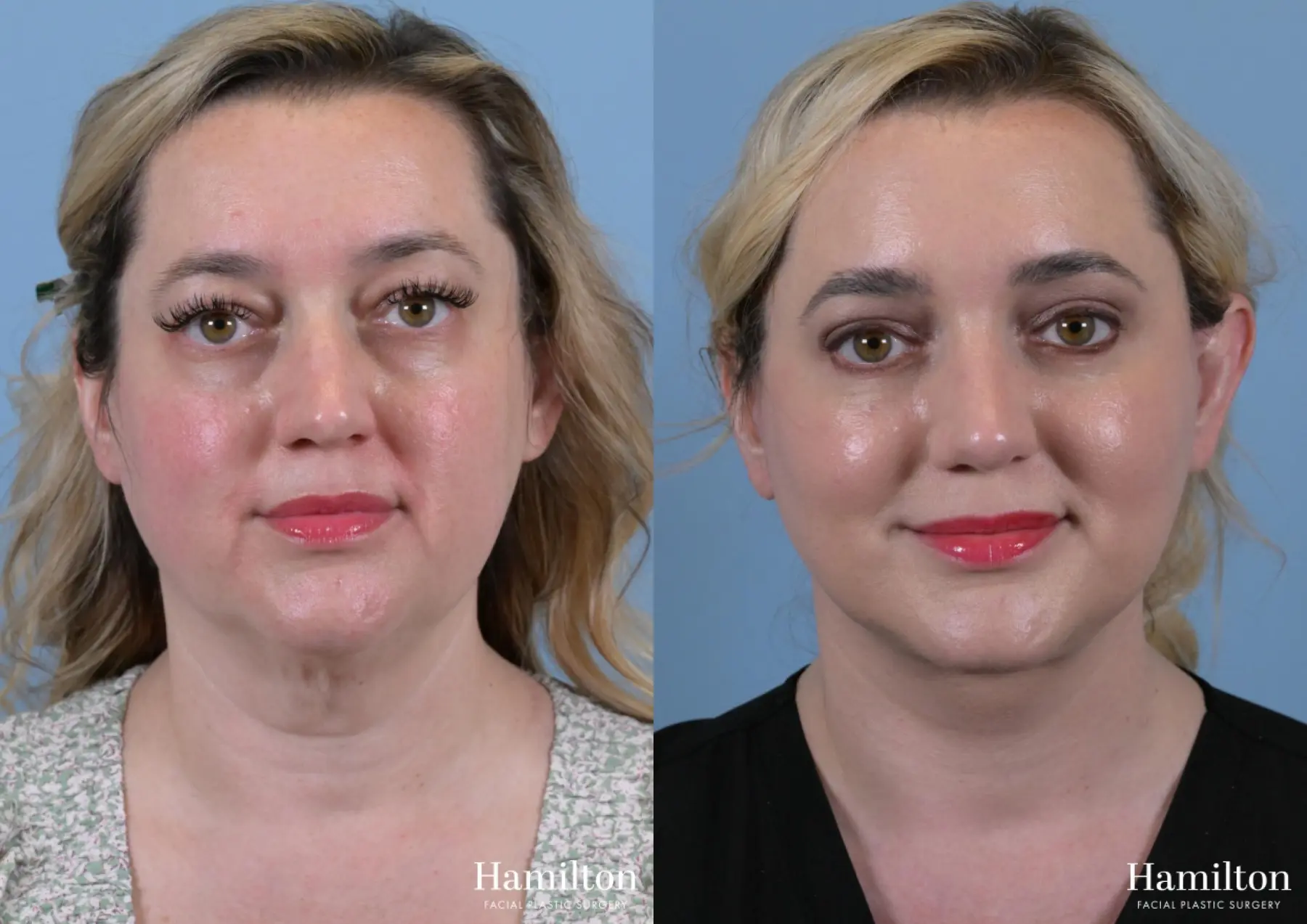 Rhinoplasty: Patient 17 - Before and After 5