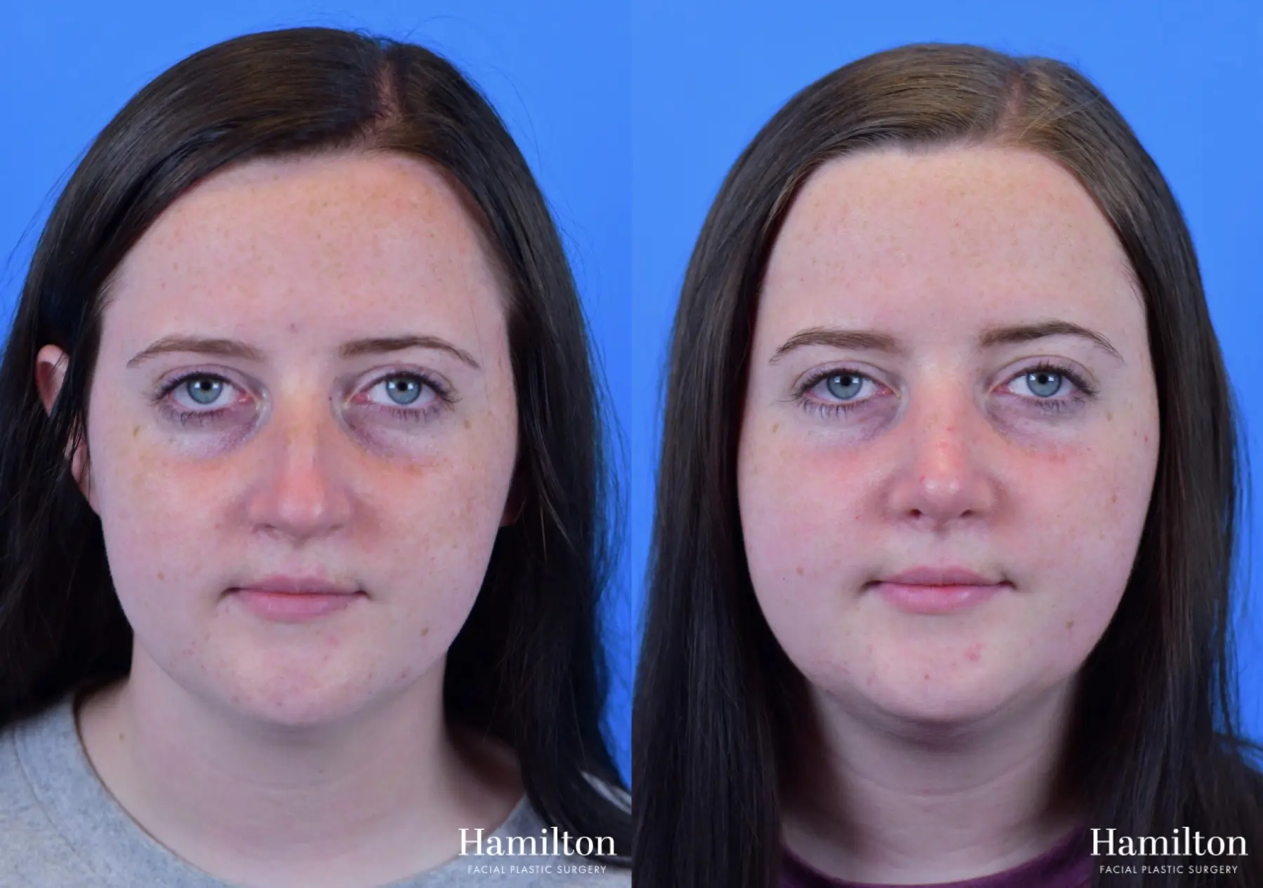 Rhinoplasty: Patient 23 - Before and After 5