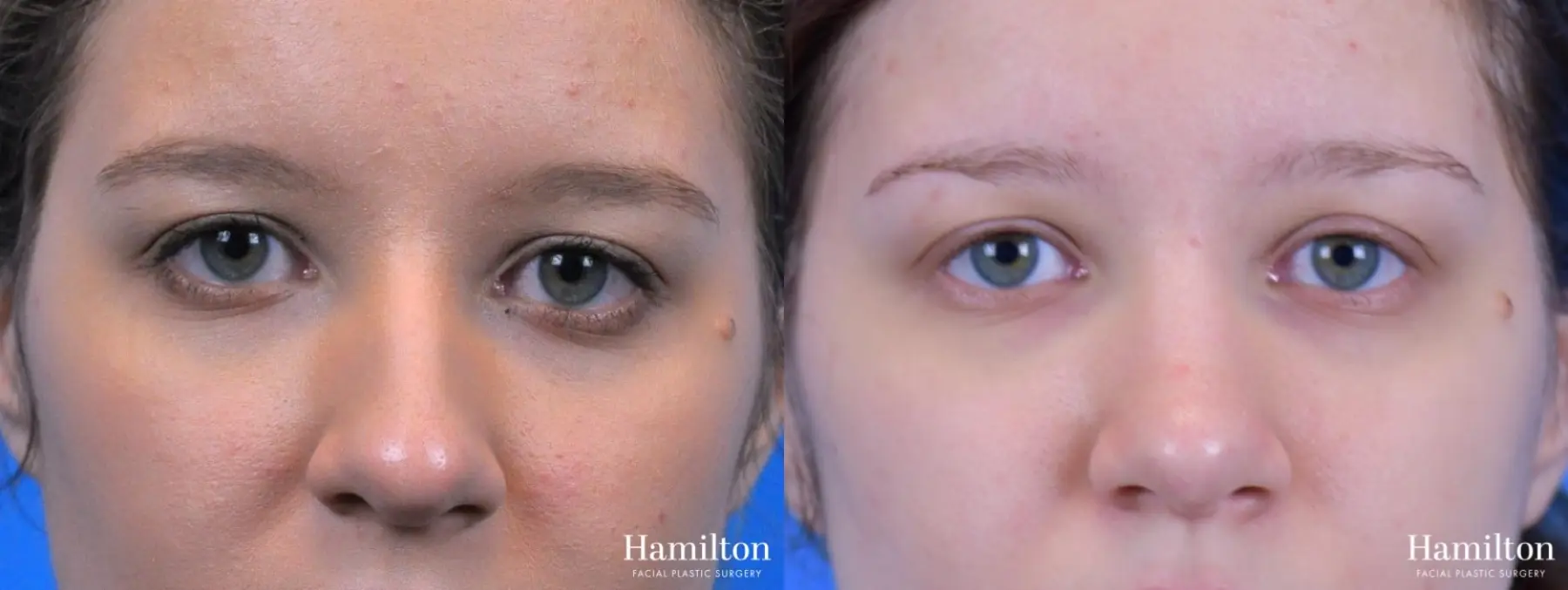 Rhinoplasty: Patient 20 - Before and After 5