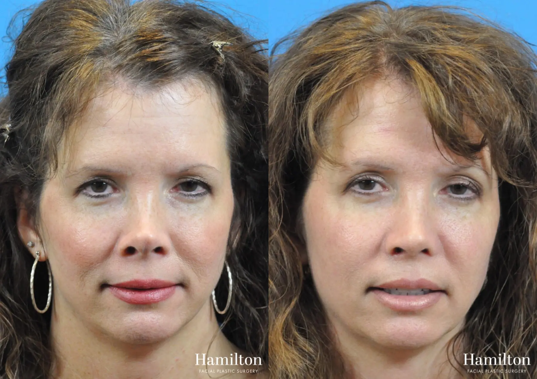 Rhinoplasty: Patient 26 - Before and After 4