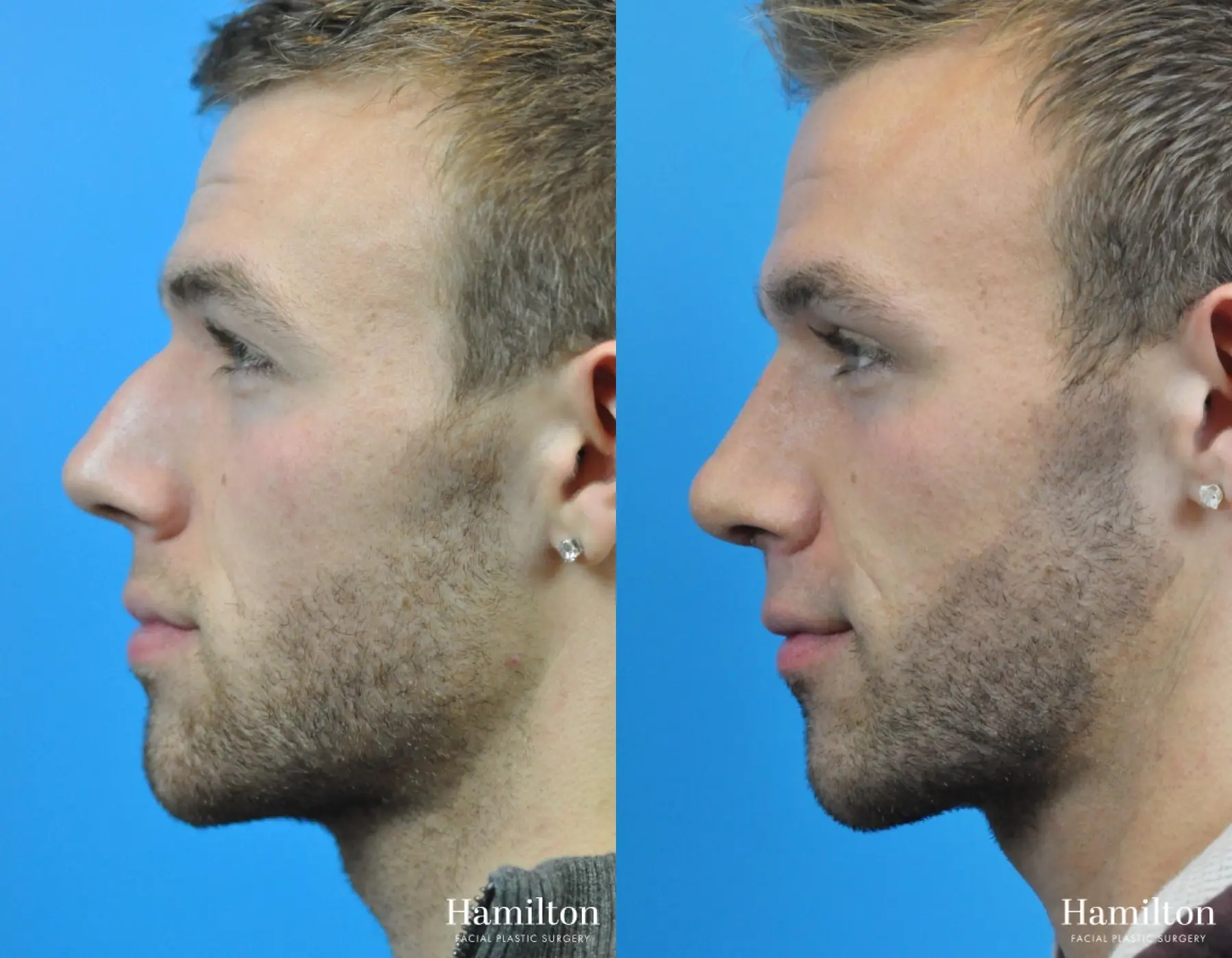 Rhinoplasty: Patient 9 - Before and After  