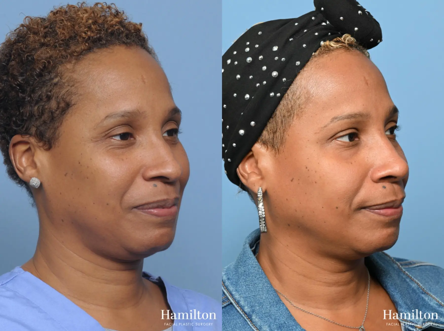 Rhinoplasty: Patient 15 - Before and After 2