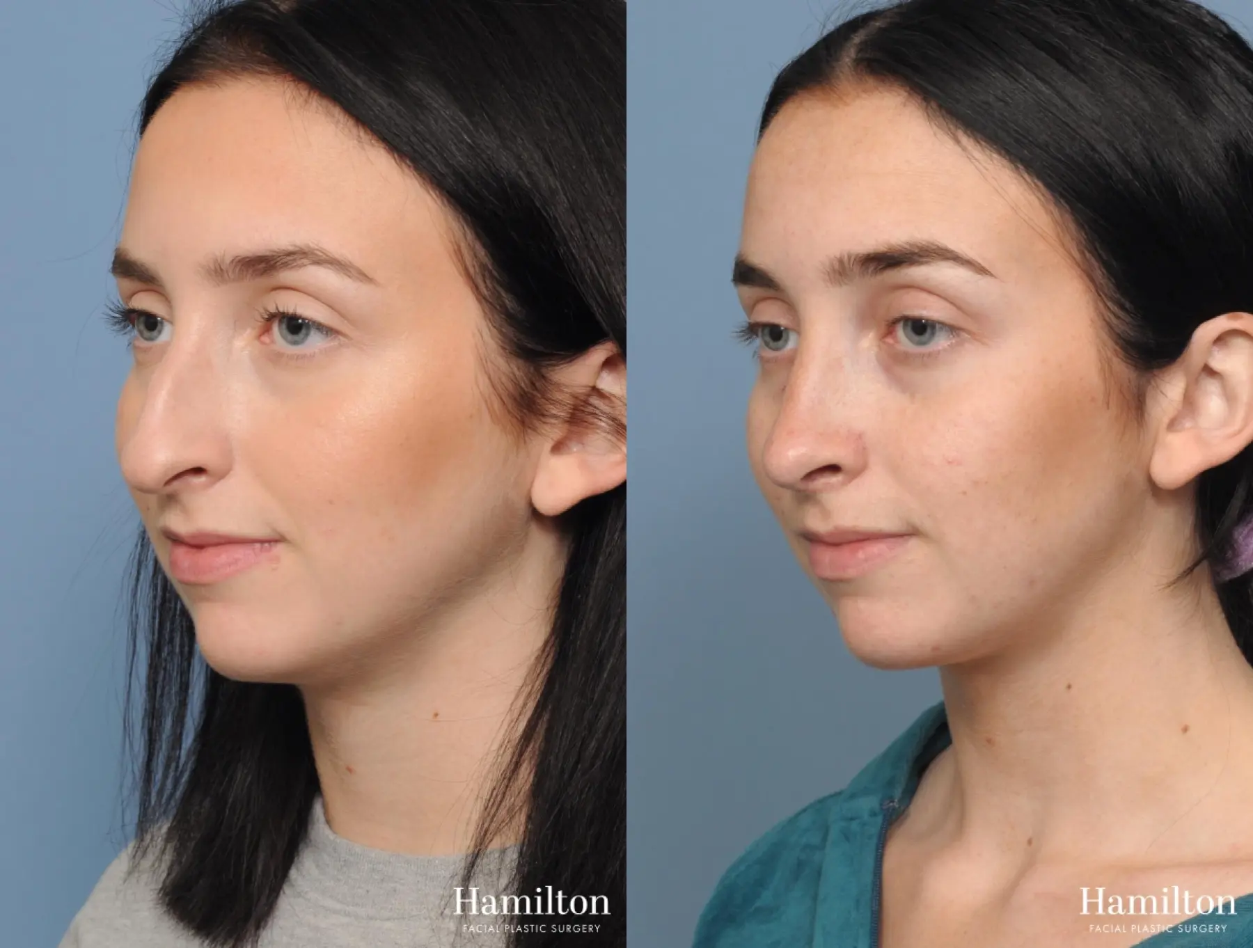 Rhinoplasty: Patient 4 - Before and After 2