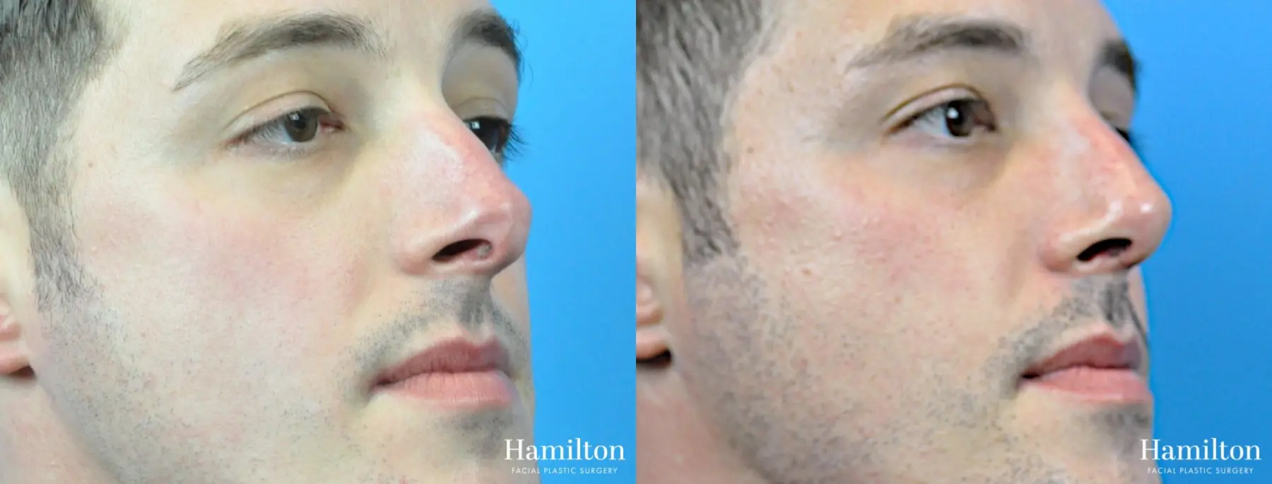 Rhinoplasty: Patient 40 - Before and After 4