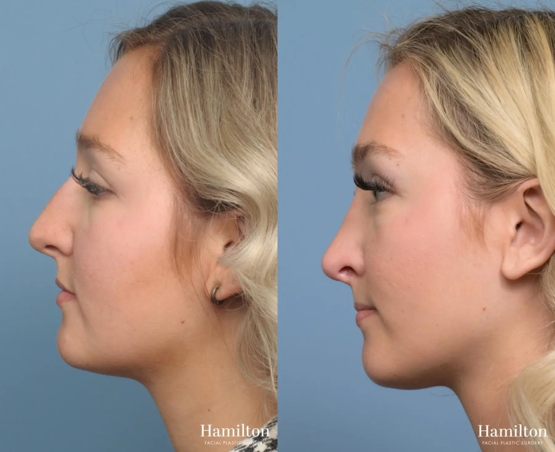 Rhinoplasty: Patient 7 - Before and After 4