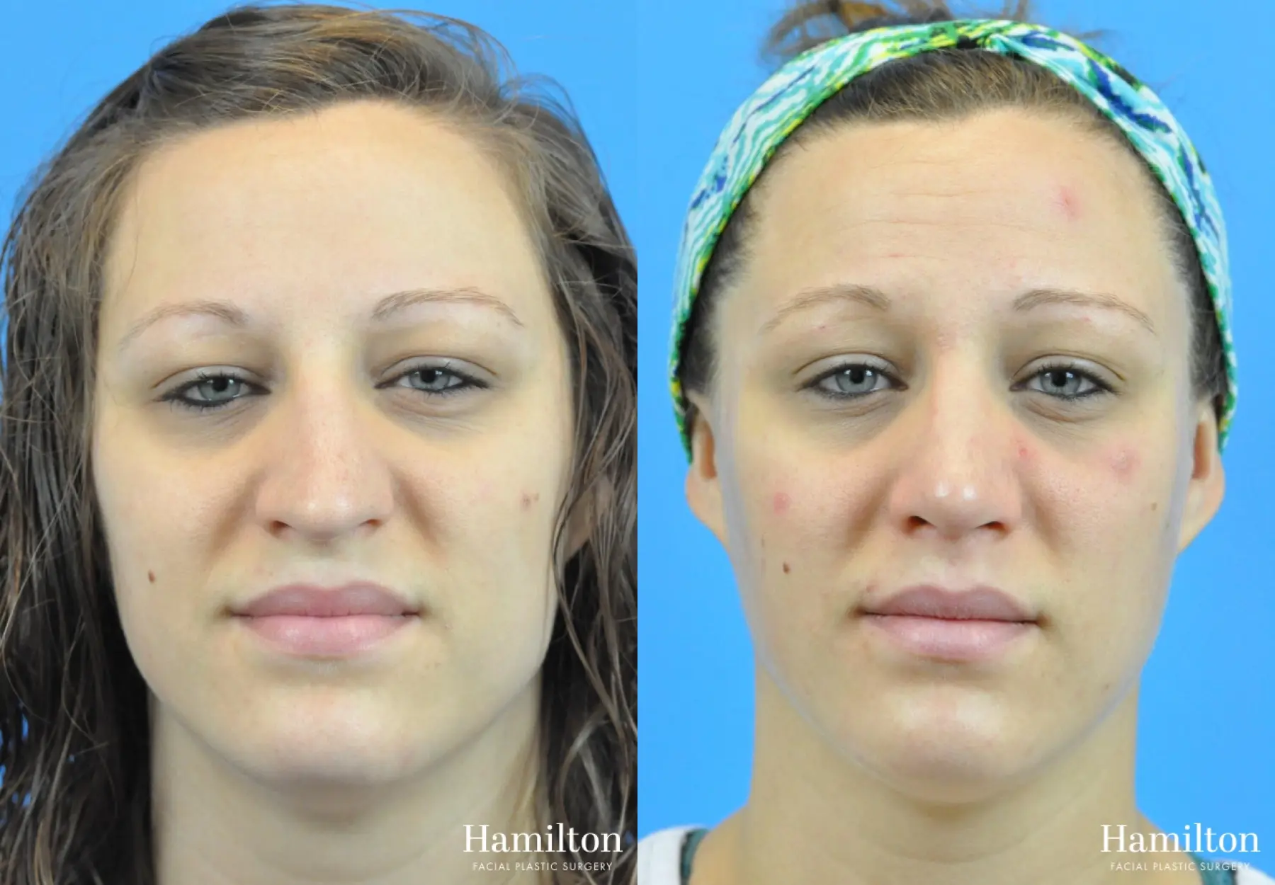 Rhinoplasty: Patient 51 - Before and After 5