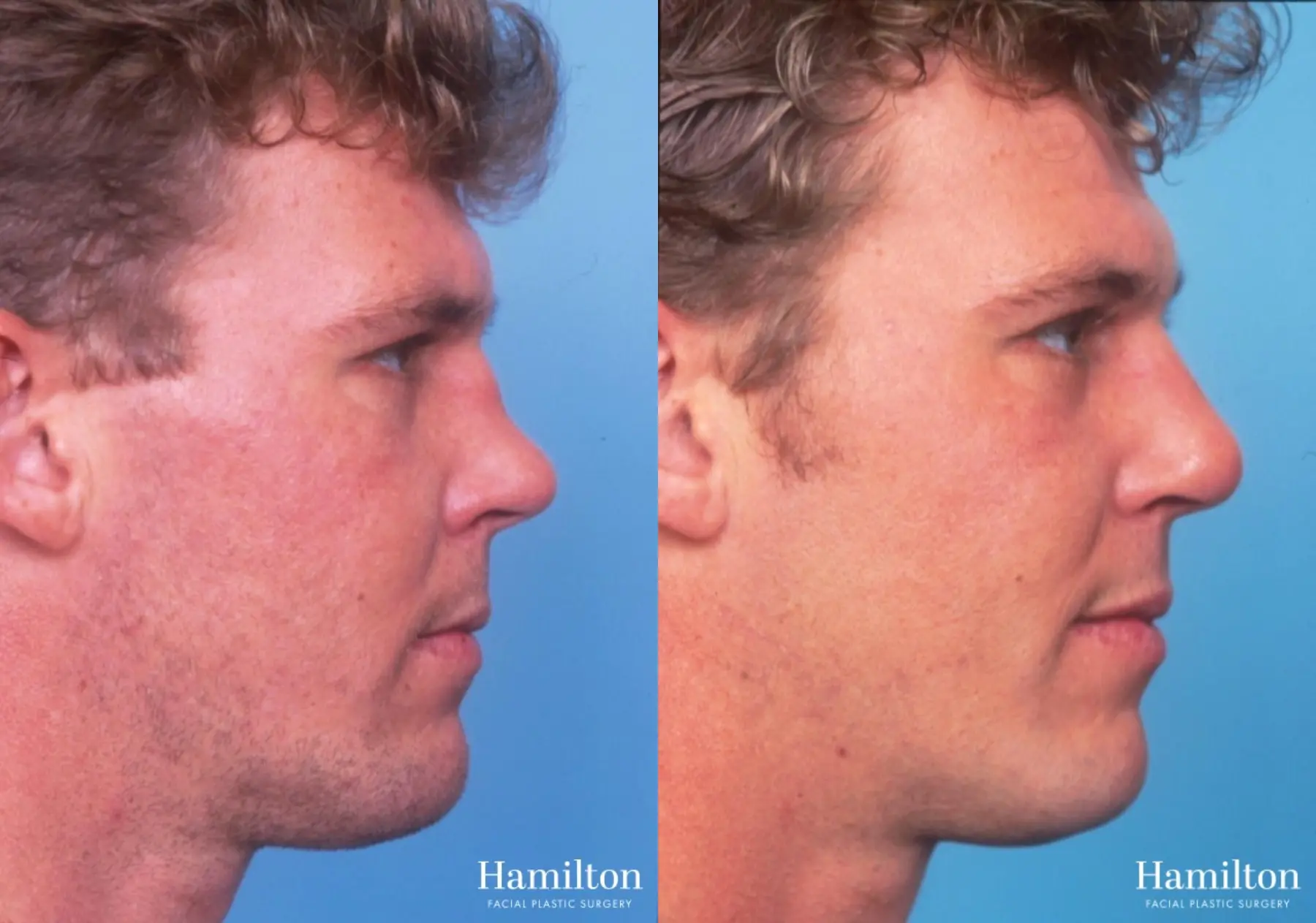 Rhinoplasty: Patient 49 - Before and After 1