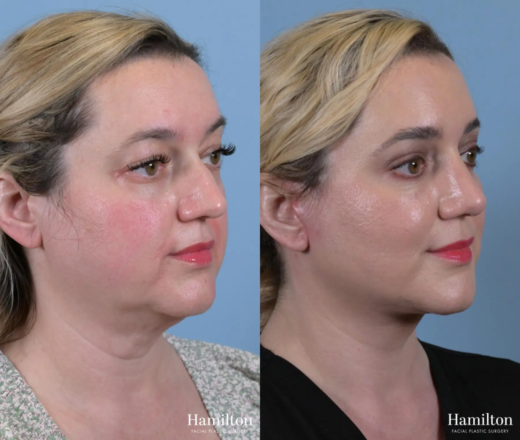 Rhinoplasty: Patient 17 - Before and After 1