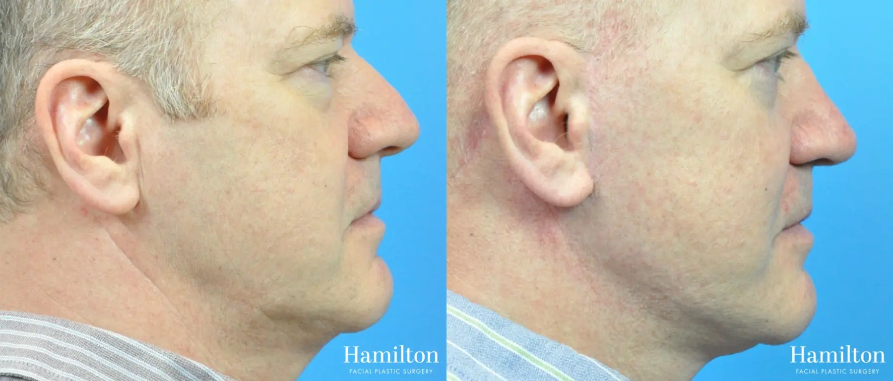 Rhinoplasty: Patient 21 - Before and After 1