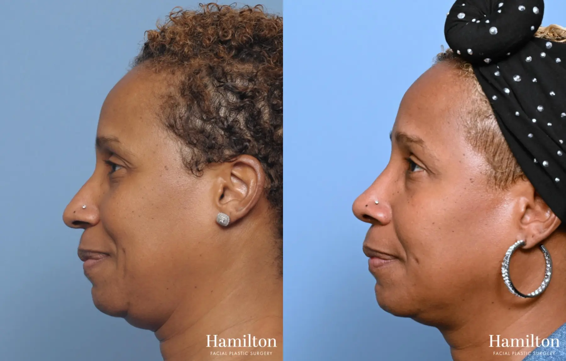 Rhinoplasty: Patient 15 - Before and After 3