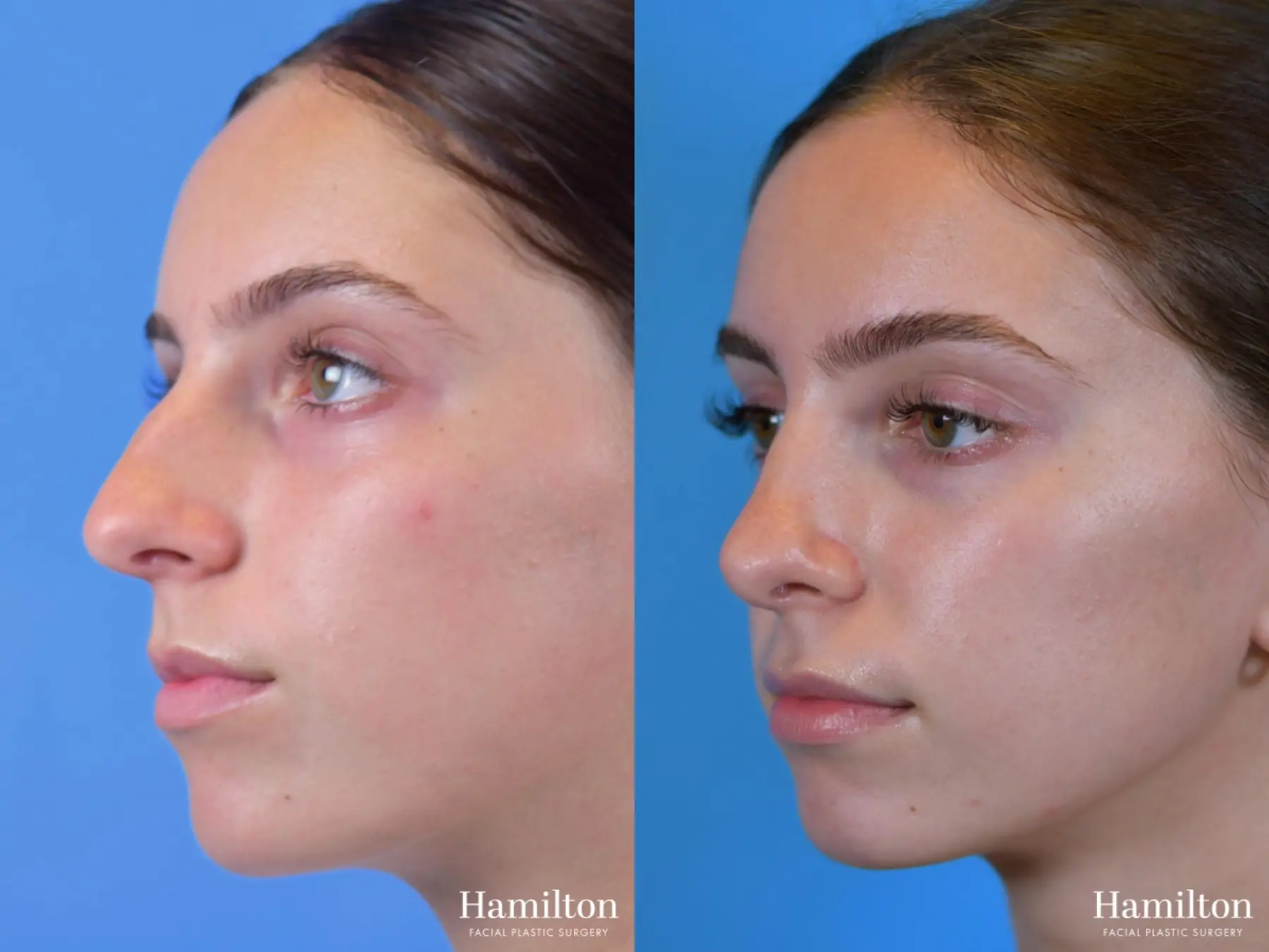 Rhinoplasty: Patient 3 - Before and After 2